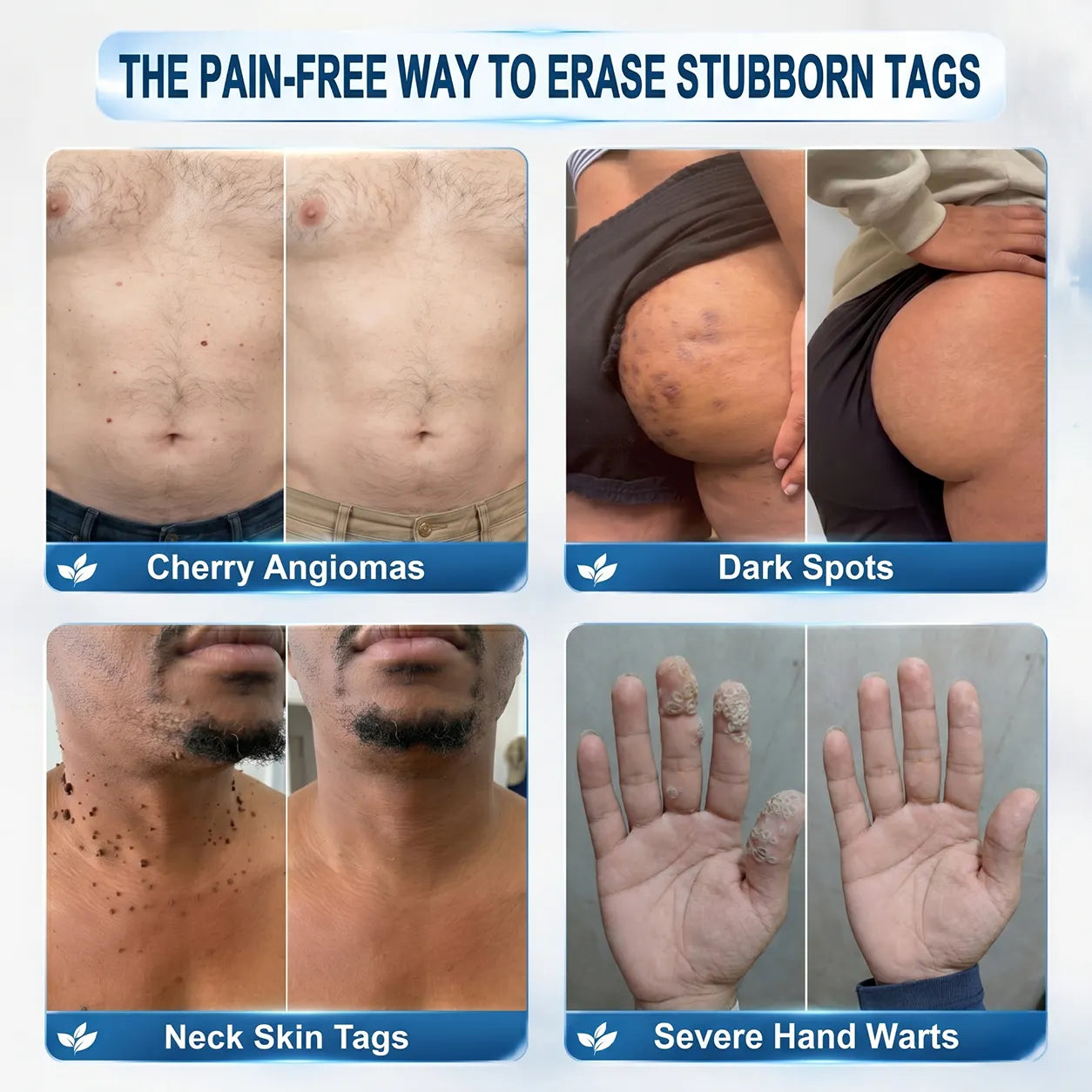 Official Brand Store |✅🧑🏻‍⚕️Natravor® 7-Day Tag & Spot Eraser(Zero Pain, Zero Scars Rollerball)