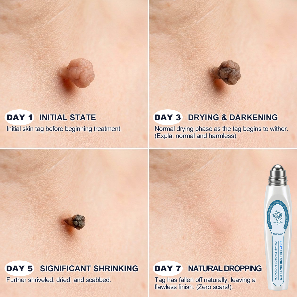 Official Brand Store |✅🧑🏻‍⚕️Natravor® 7-Day Tag & Spot Eraser(Zero Pain, Zero Scars Rollerball)